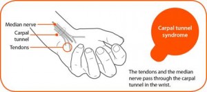 Carpal tunnel syndrome (CTS) 