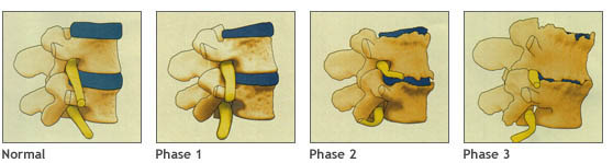 Chiropractic Adjustments Prevent Spinal Degeneration