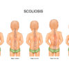 Detection of Scoliosis – Spinal Care for Children is a Must Основные RGB