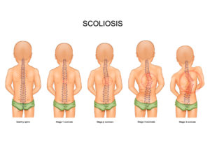 illustration of childhood scoliosis severity