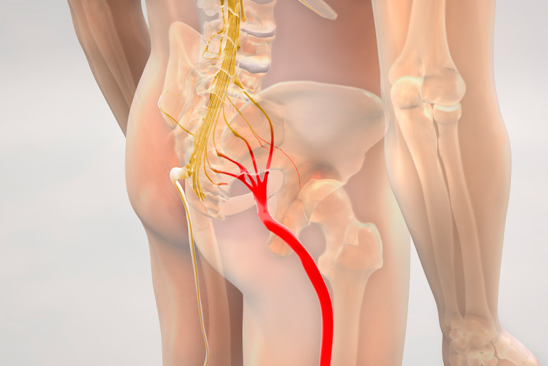 SCIATICA